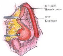 示意圖15:游離、牽引食管下段