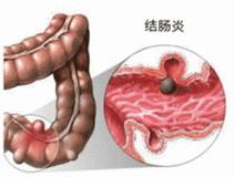 結腸炎