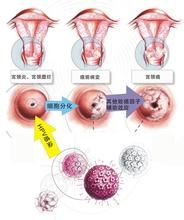 子宮腫瘤變異