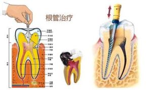 牙根炎