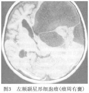 星形細胞瘤