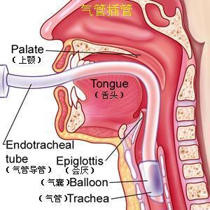 醫源性氣管及主支氣管損傷