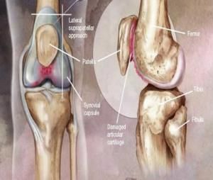 膝關節半月軟骨損傷