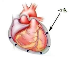 心包穿刺