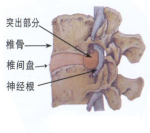 腰間盤突出症