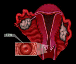 妊娠合併甲狀旁腺功能亢進