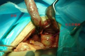 先天性膽管擴張症手術