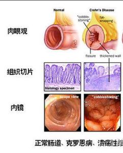 克羅恩病