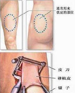 游離皮片移植