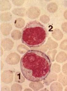 單核細胞白血病
