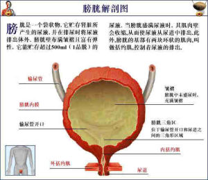 特發性高鈣尿症