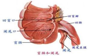 闌尾炎穿孔