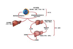 丙型病毒性肝炎