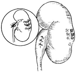 非特異性腎實質疾病