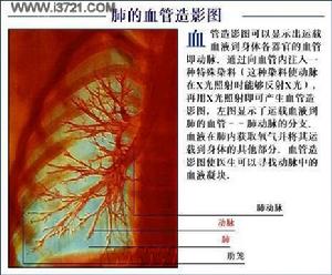 肺血管炎