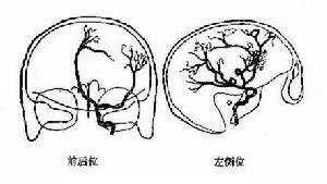 小腦腦橋角腦膜瘤