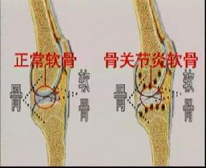 痛風性關節炎