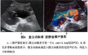 腹主動脈腔靜脈瘺