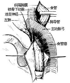 主動脈夾層分離