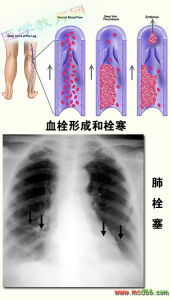 肺栓塞