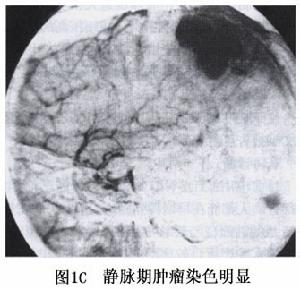 大腦凸面腦膜瘤