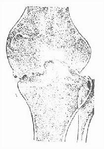 （圖）膝關節結核