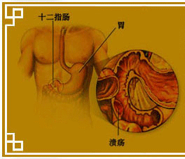 蛋白丟失性胃腸病