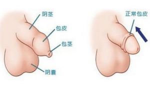 微創無痕包皮環切技術