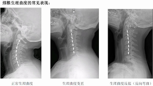 自然曲度變直