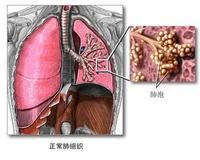 急性呼吸窘迫綜合症