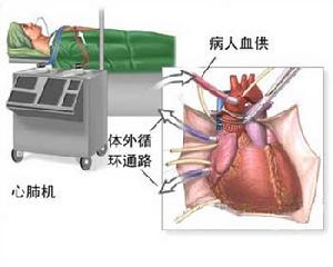 心臟搭橋手術