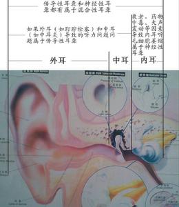 （圖）感音性耳聾