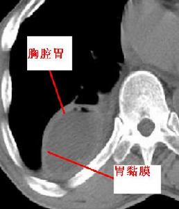 酒精性腦萎縮