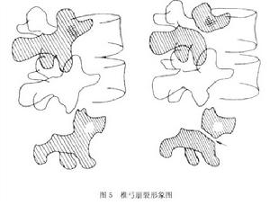 （圖）腰部峽部崩裂和脊椎滑脫