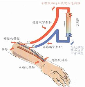 人工腎透析過程