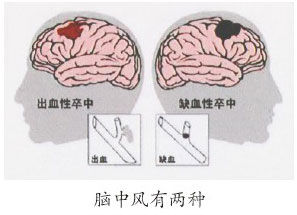 腦卒中後癲癇