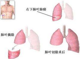 肺葉切除術