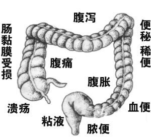 過敏性結腸炎