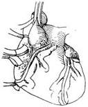 （圖）冠狀動脈異位起源