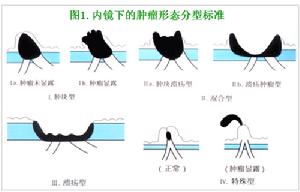 （圖）壺腹周圍癌