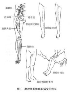 股神經乾性痛