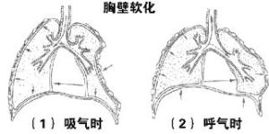 連枷胸