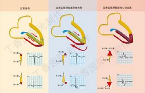 雙側束支傳導阻滯