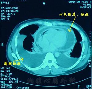X射線下心包炎