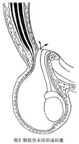 小兒腹股溝斜疝