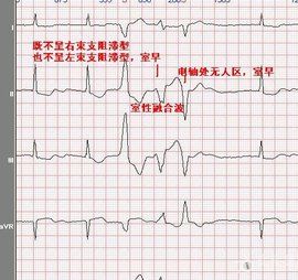 室性融合波