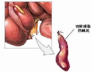 老年急性闌尾炎