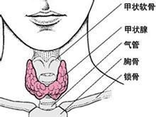 橋本甲狀腺炎