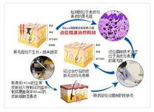 點位精準治療