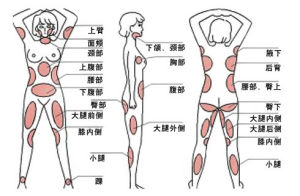 雙弧柔性吸脂減肥